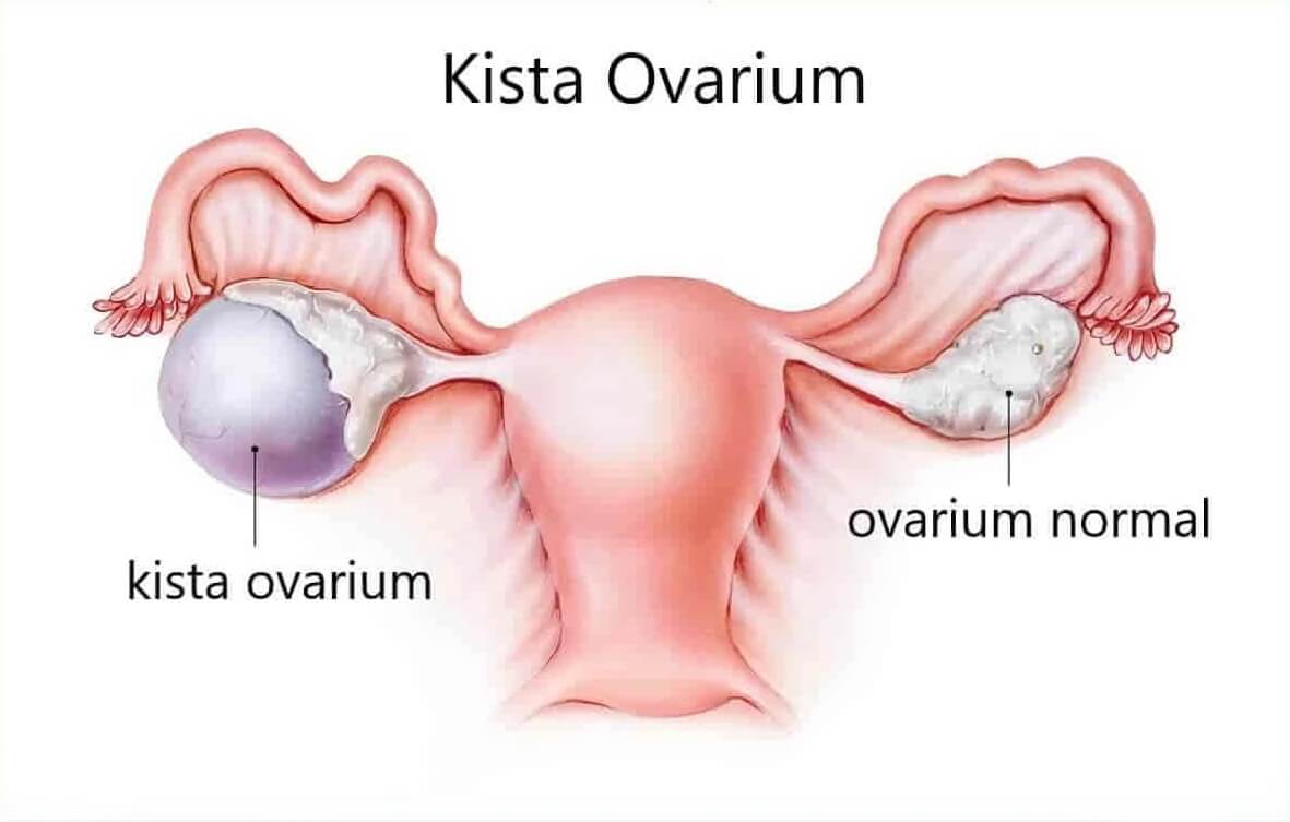 kista-ovarium